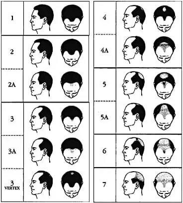 mens hair loss patterns