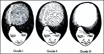 womens hair loss pattern